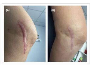 Before and after 8 week of scar massage