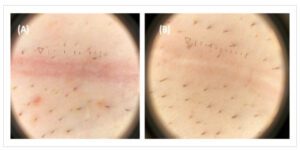 Microscope view of C-section scar before (A) and after (B) some manual scar therapy